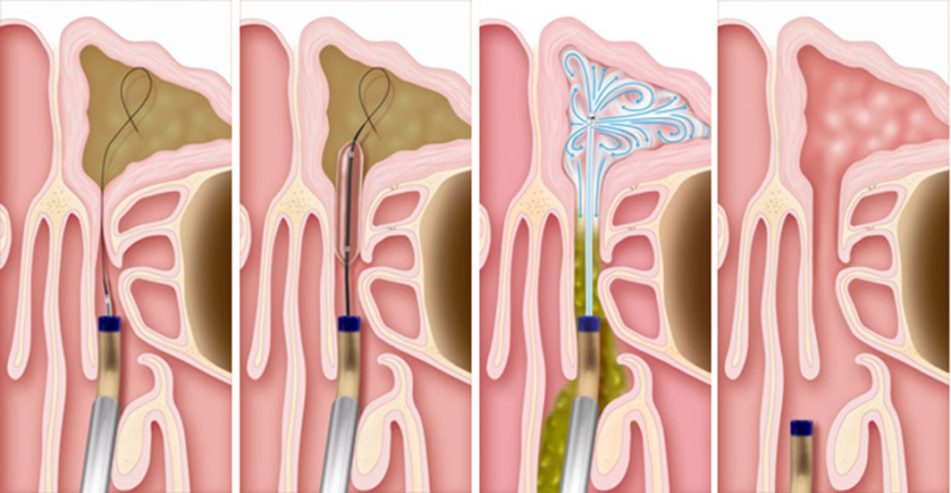 Nose-02-BalloonSinuplasty