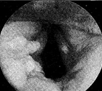 Penetrating Laryngotracheal trauma. 2003